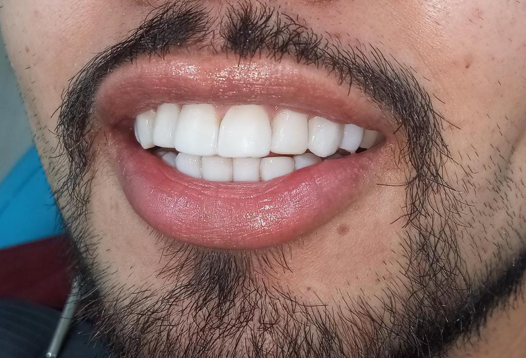 despues