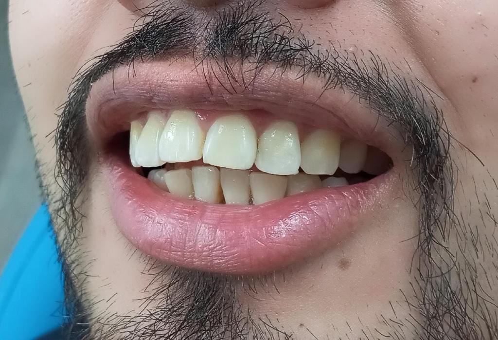 antes
