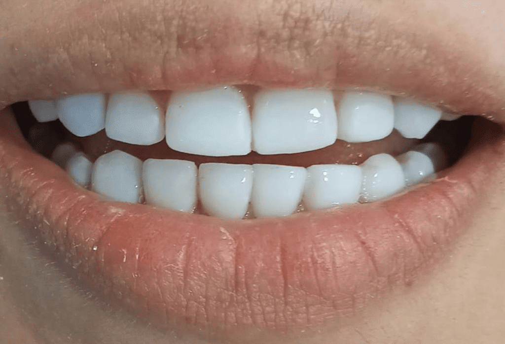 carillas dentales