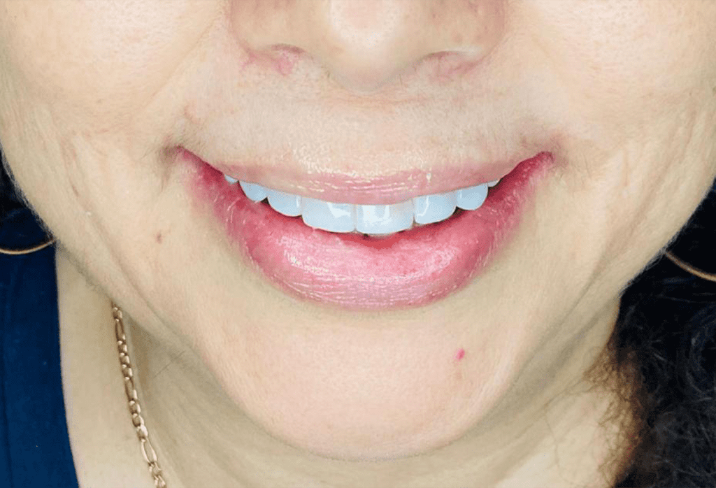 precio carillas dentales en monterrey