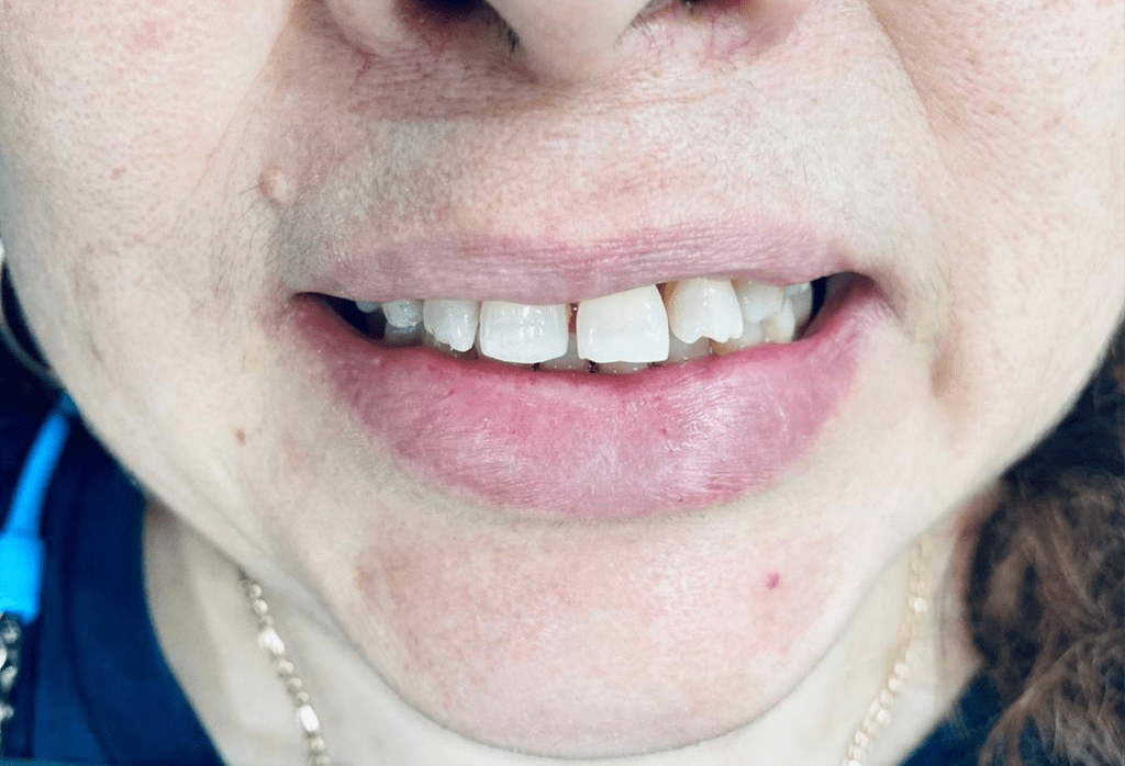 precio carillas dentales monterrey